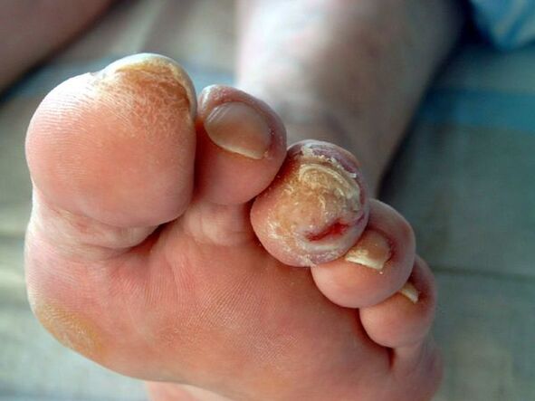 Diabetic foot and onychomycosis