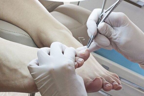 Mechanical elimination of nail affected by fungi