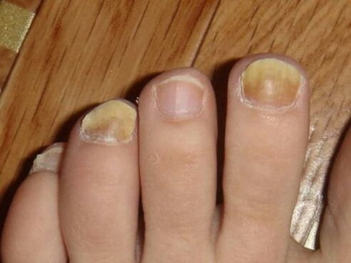 Foot fungus with nail damage.